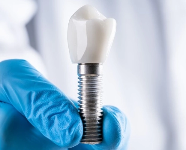 Dental Implant
