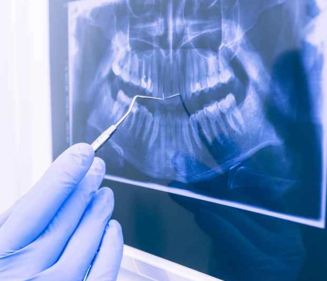 Importance of Dental X-ray