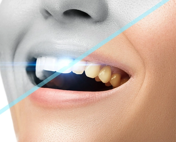 Teeth Whitening Treatment